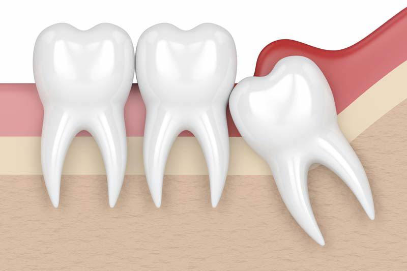 Tooth Extractions Albemarle